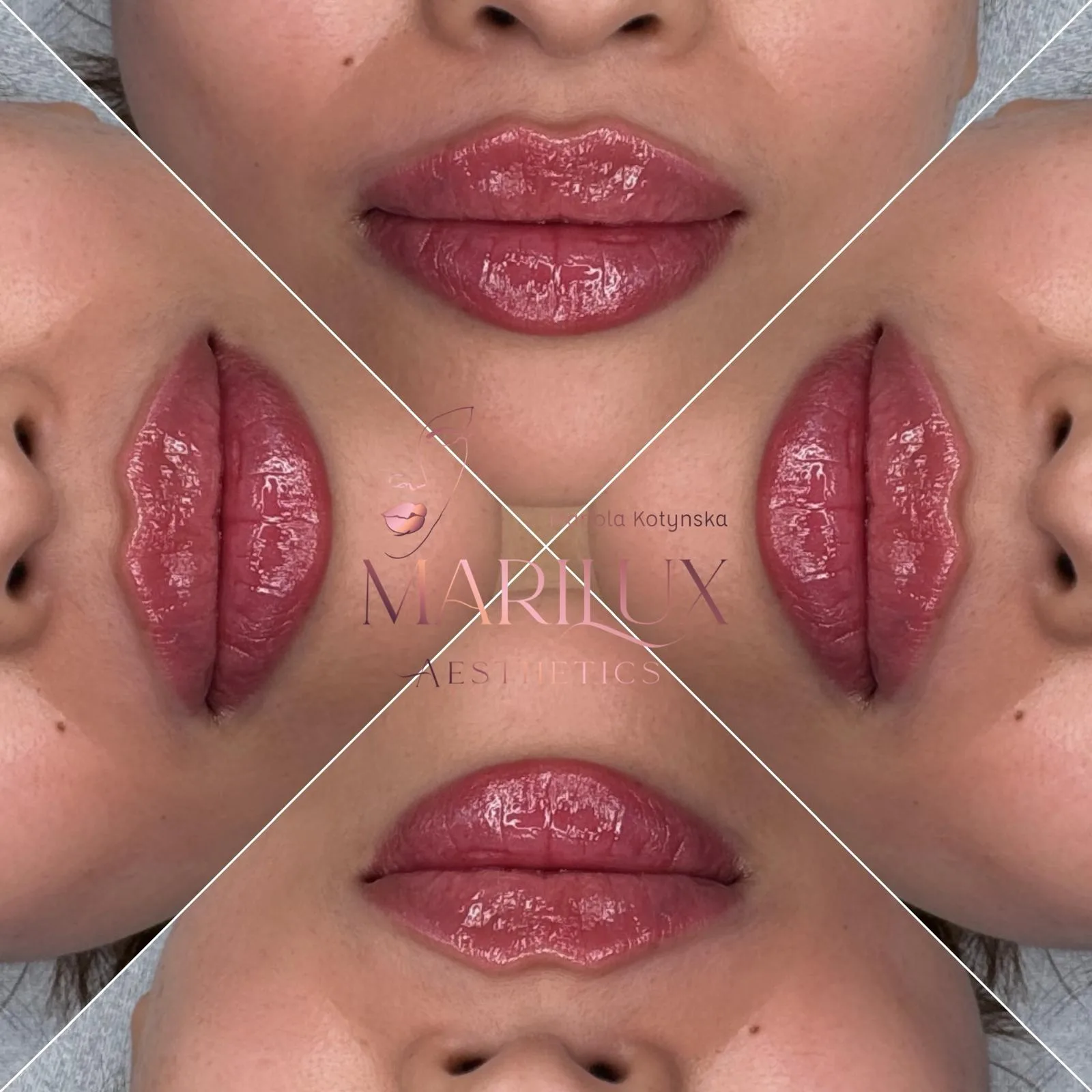 Full lips after dermal filler treatment — Marilux Aesthetics, Sligo