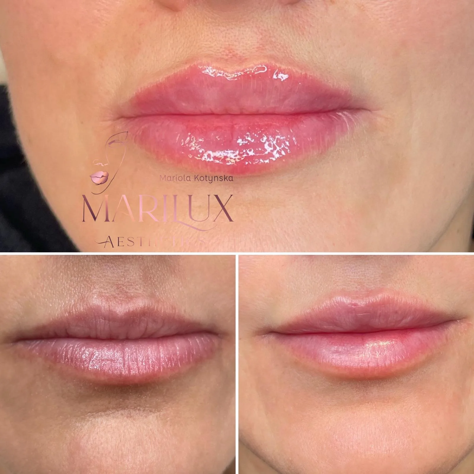 Thin lips transformed with dermal filler — before and after, Sligo