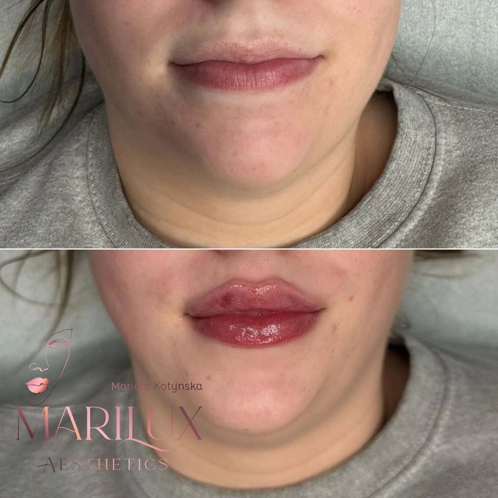 Fuller lips transformation with lip filler — before and after, Sligo