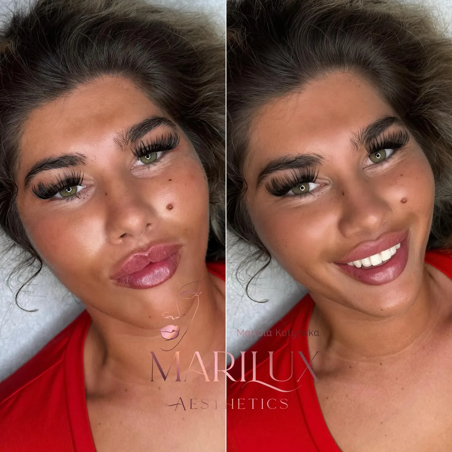 Lip filler results — natural plump lips by Marilux Aesthetics